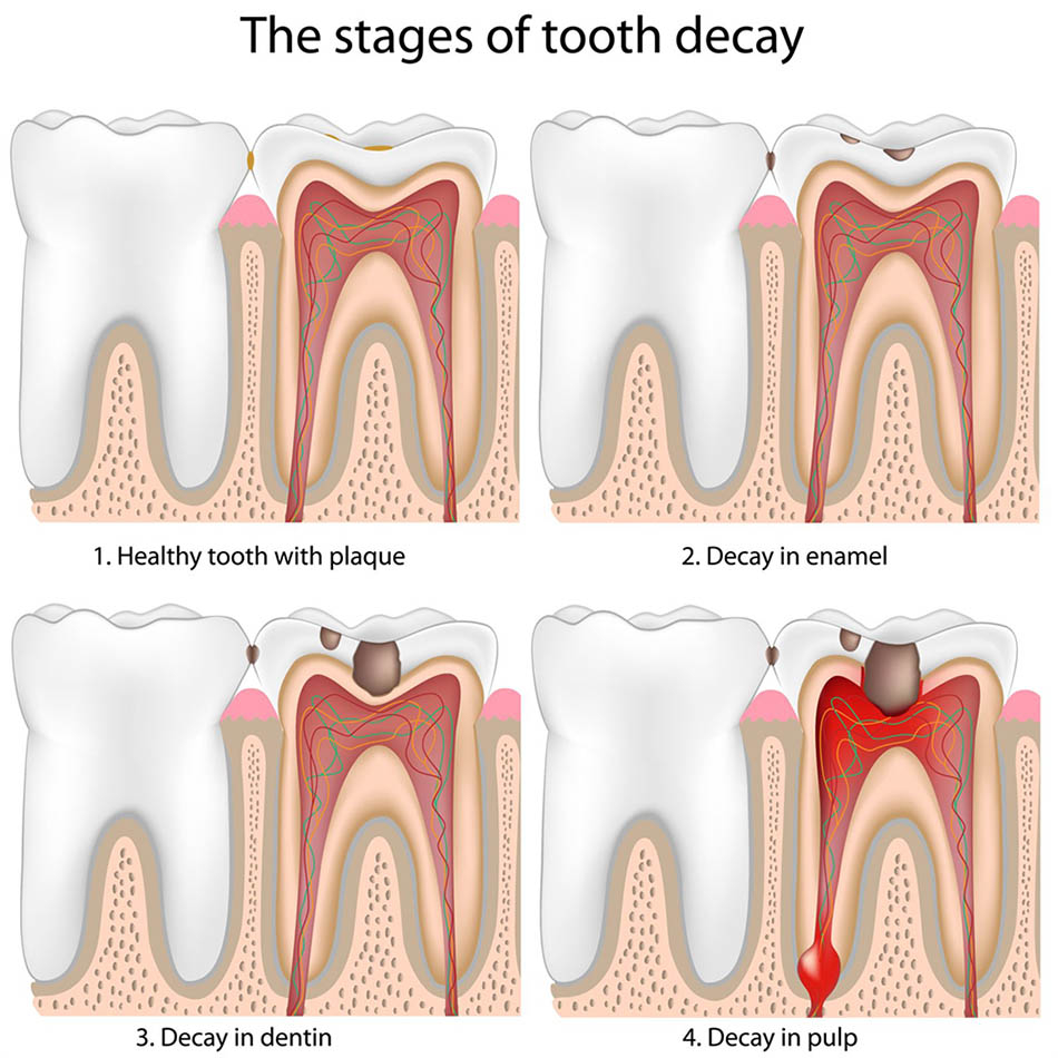 <img src=“tooth decay.png” alt=“tooth decay randwick”>