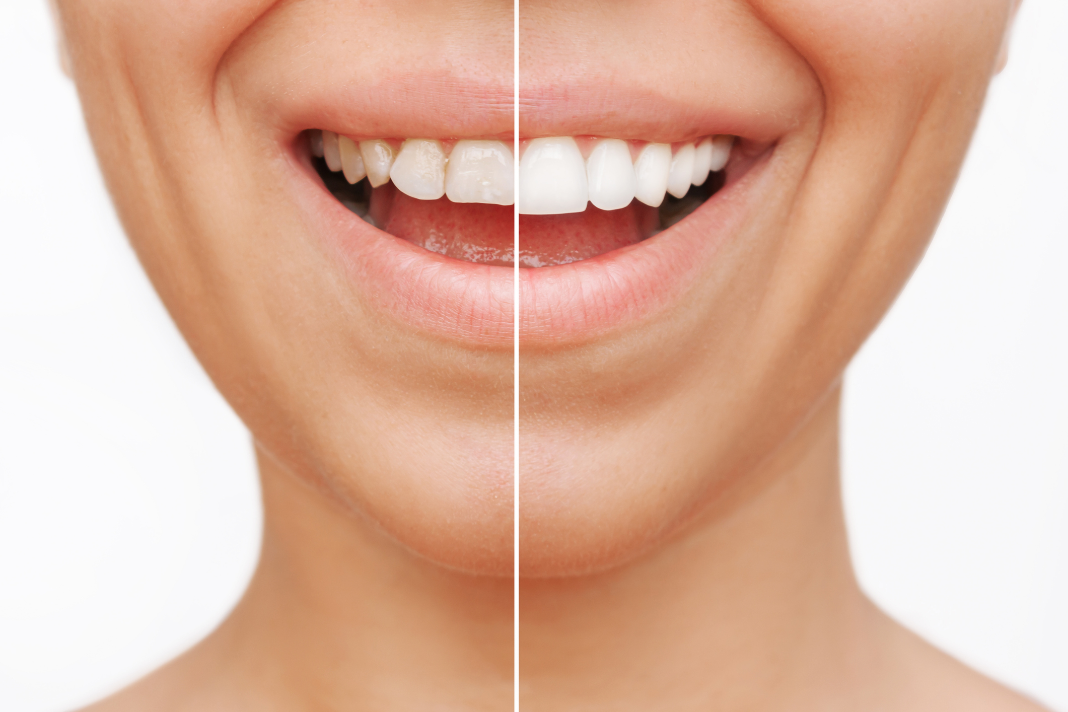 Teeth Whitening vs Veneers