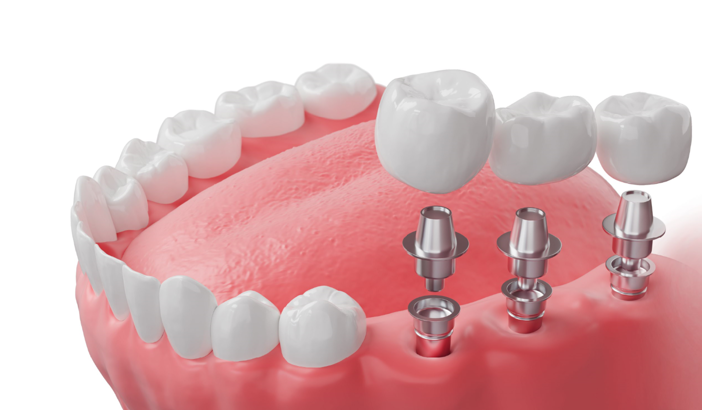 Dental Implants at Vital Dental: A Long-Term Solution for Tooth Loss