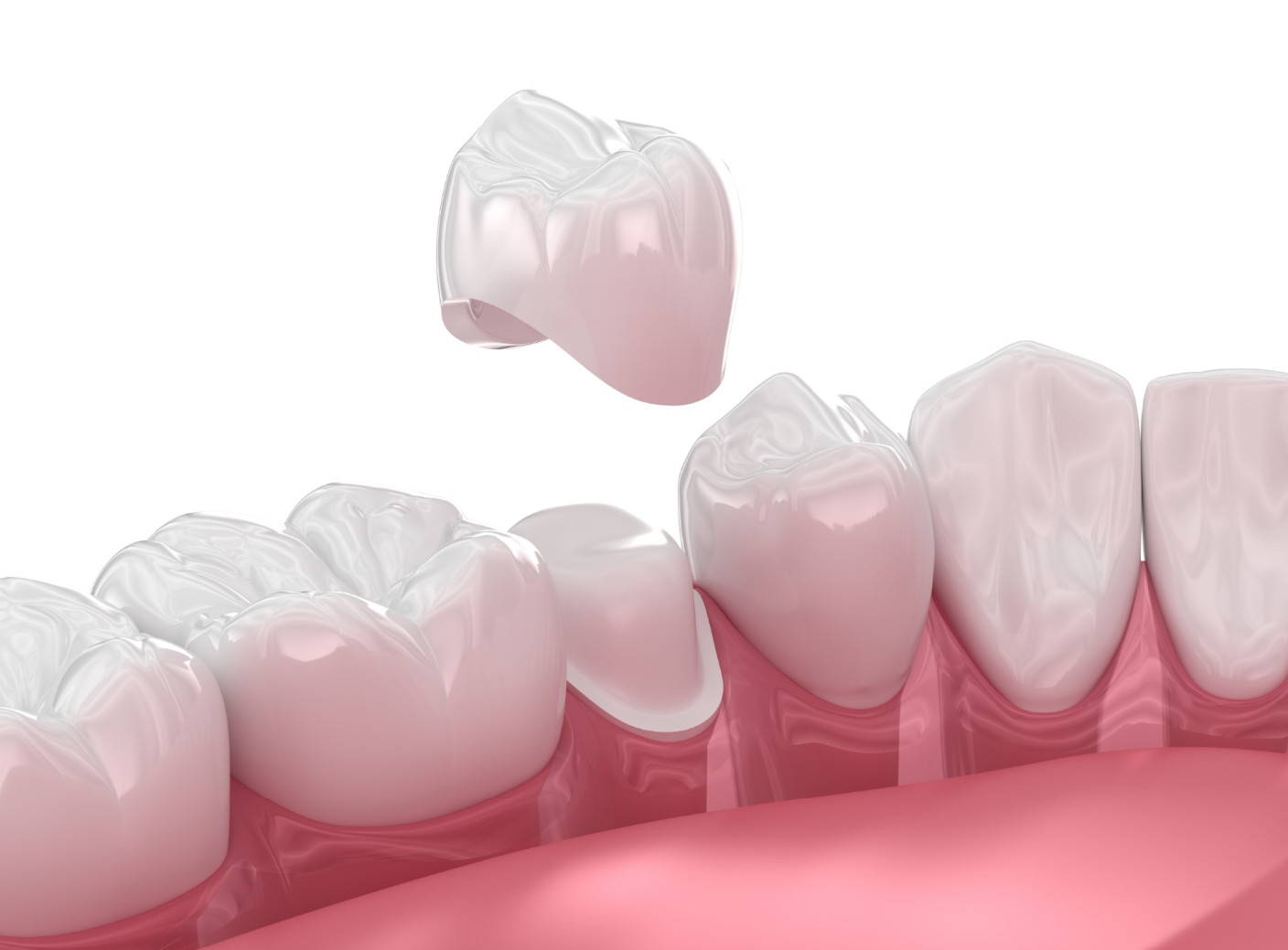 Dental Crowns vs Fillings: Understanding Your Options at Vital Dental